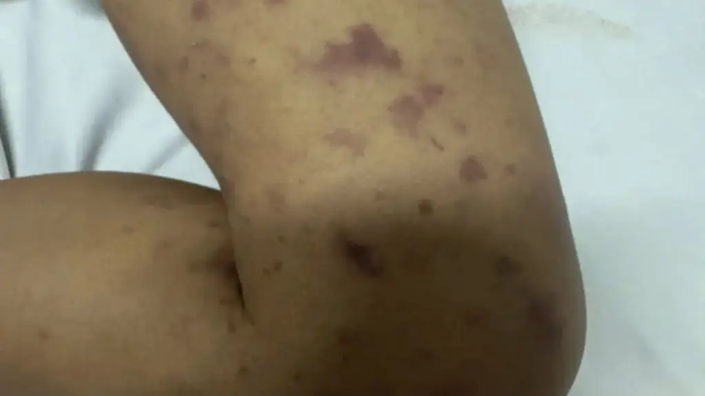 Bé 2 tuổi tử vong do viêm não mô cầu, người thân phải cách ly y tế