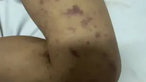 Bé 2 tuổi tử vong do viêm não mô cầu, người thân phải cách ly y tế
