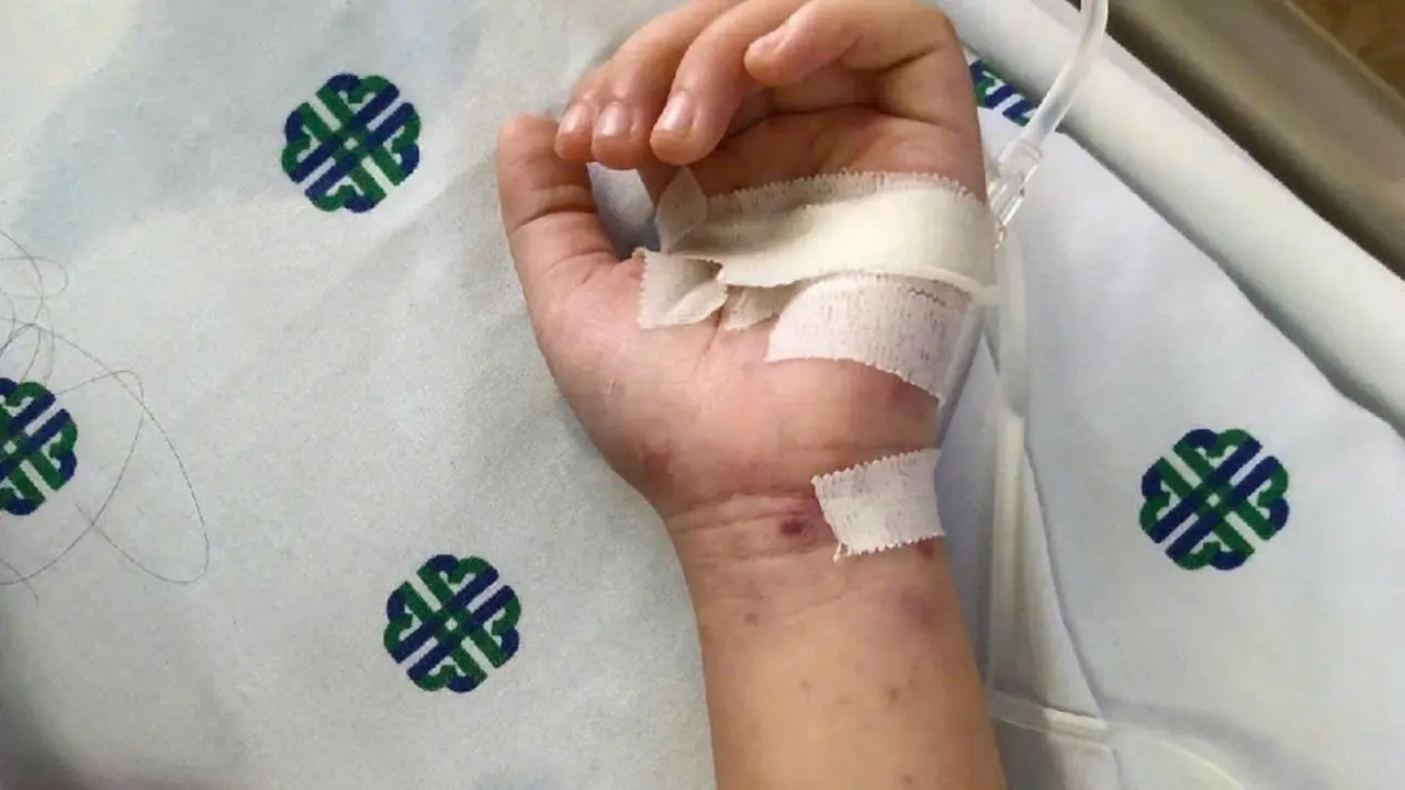TP.HCM: Bé 11 tuổi tử vong do viêm màng não mô cầu thể tối cấp, diễn tiến rất nhanh