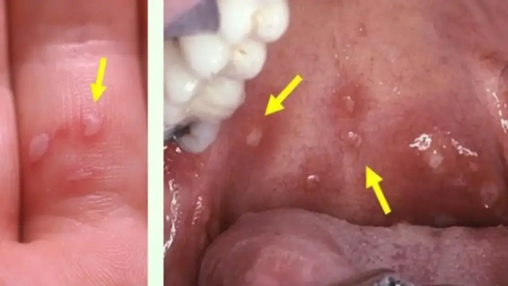 TP.HCM: Biến thể mới gây tay chân miệng nguy hiểm thế nào?