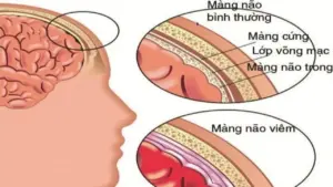 Bé 5 tuổi tử vong do viêm màng não mủ, lấy mẫu xét nghiệm 35 trẻ cùng lớp