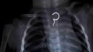 Bé gái 8 tháng tuổi ho, quấy khóc kéo dài, bác sĩ sốc nặng khi gắp ra thứ "đáng sợ"