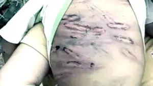 Bé trai 2 tuổi nghi bị mẹ ruột và người tình bạo hành: Bé được chẩn đoán dập lách, gan, đứt tụy...