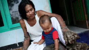 Bí ẩn dị nhân biến thành “quái vật rừng” vì căn bệnh lạ kéo dài gần 3 thập kỷ