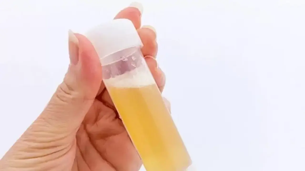 Đi tiểu nhiều bọt có phải suy thận?