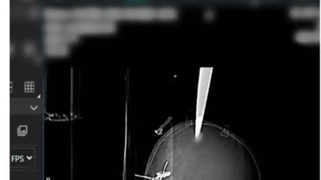 Một phút bất cẩn khi vui chơi, bé 11 tuổi gặp chấn thương nghiêm trọng