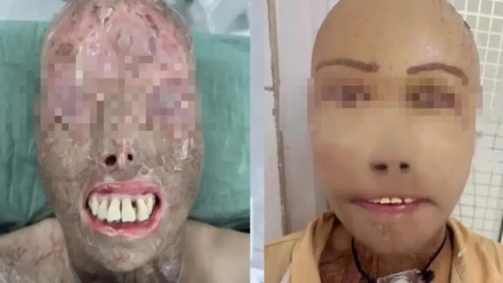 Ngã vào nồi nước sôi và hành trình 16 giờ 'trao trả' gương mặt