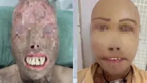 Ngã vào nồi nước sôi và hành trình 16 giờ 'trao trả' gương mặt