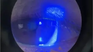Suýt mất thị lực một mắt vì môn thể thao đang “gây sốt”