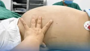Thiếu nữ 19 tuổi tưởng béo bụng, bác sĩ hút 10 lít dịch từ khối u khổng lồ