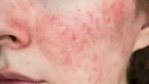 Thử thách "nguy hiểm cho da" để tự chữa lành gây tranh cãi