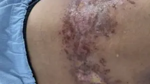 Zona thần kinh có lây không, cách nào phòng tránh?